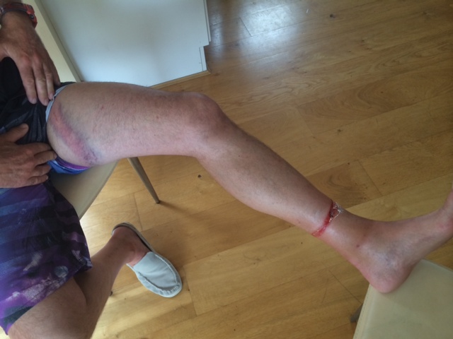 Mings leg